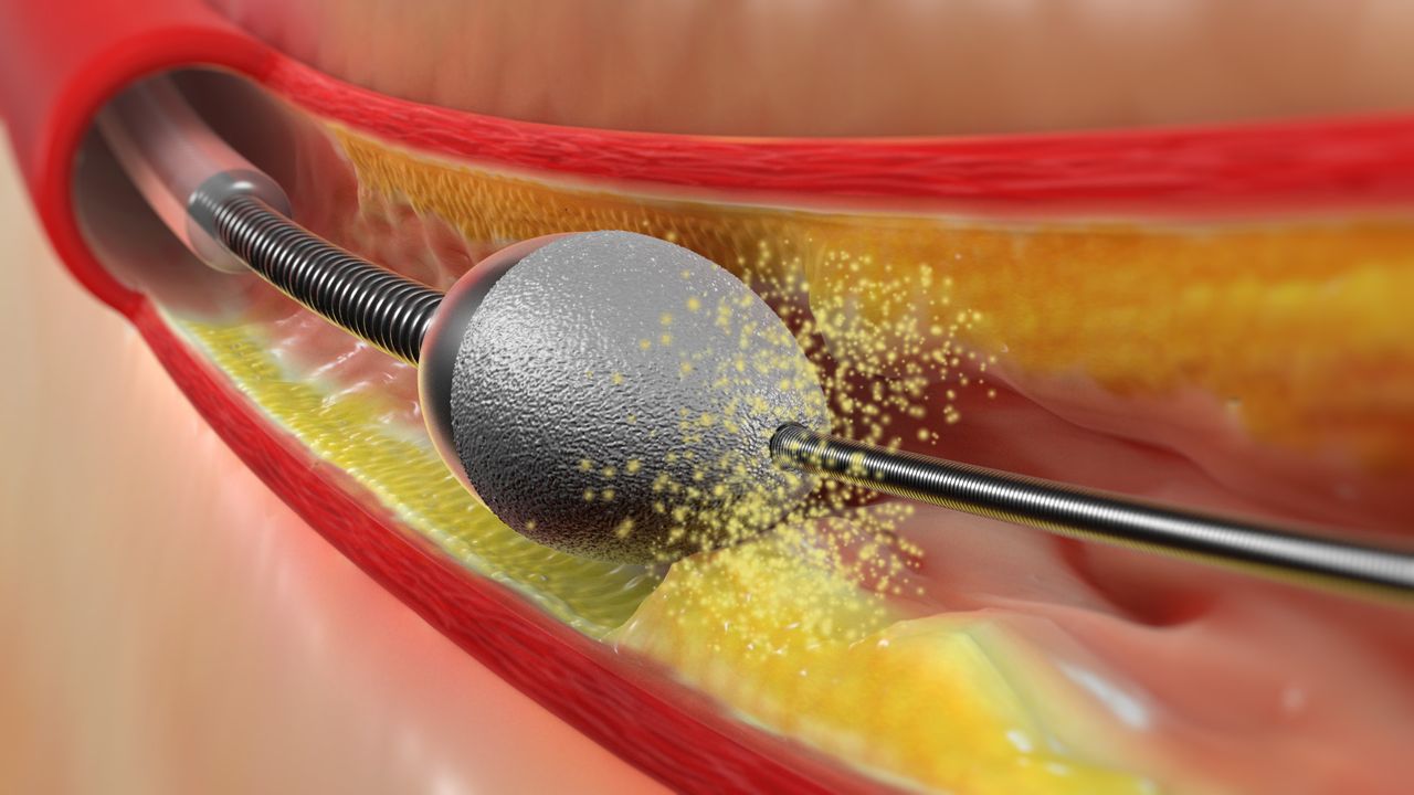 Atherectomy
